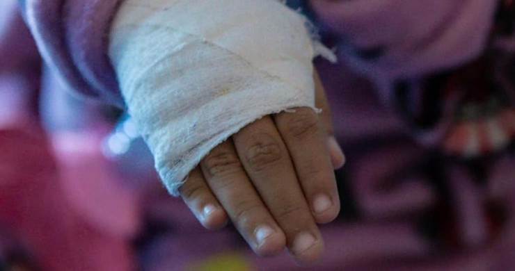 En un 33 % aumentaron los lesionados por pólvora en el Cesar