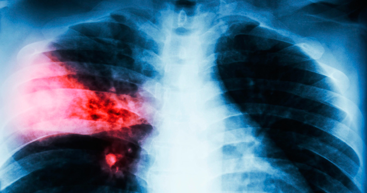 La clave contra el cáncer de pulmón podría estar en un inesperado ‘interruptor metabólico’